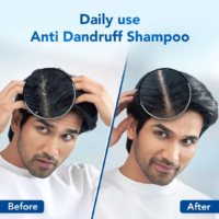 Scalpe Pro Anti-Dandruff Shampoo Review